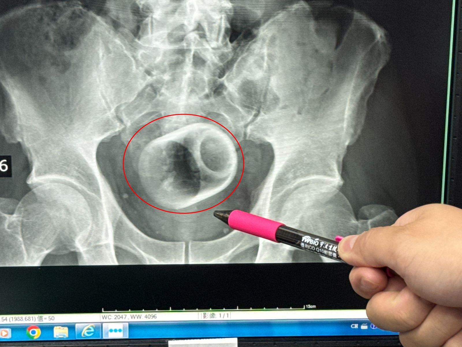 男子3天無法排便！醫檢查大驚：菊花裡面有瓷杯　下場超慘