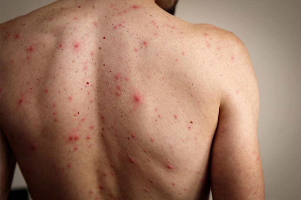 赴日看WBC經典賽當心！麻疹疫情創7年新高 醫曝：口罩擋不住