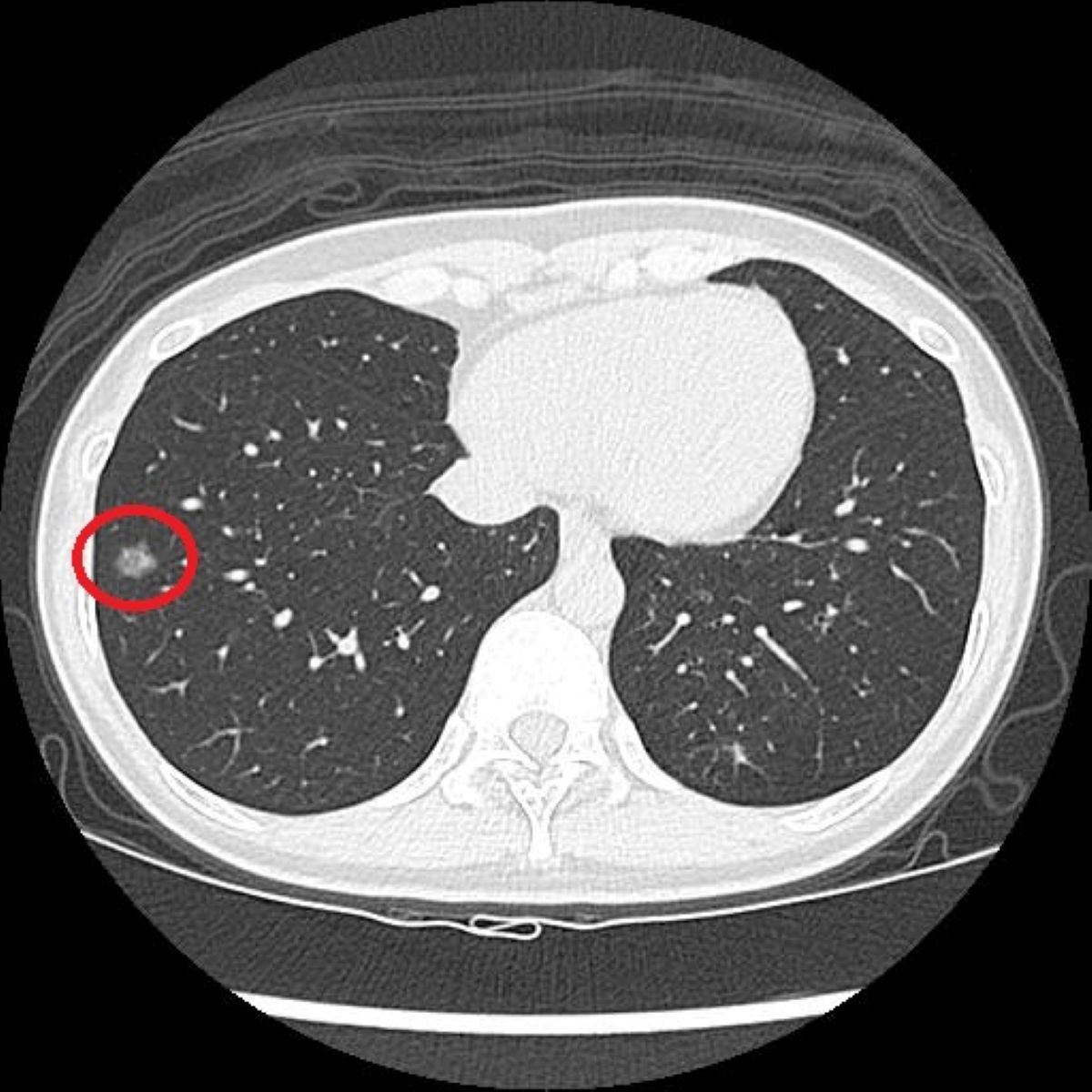 戒菸2年仍罹肺癌！41歲女靠「這篩檢」揪出1.2公分結節救命　醫揭關鍵